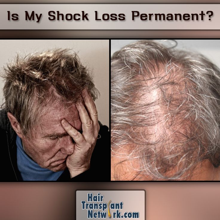 Is My Shock Loss from My Hair Transplant Permanent?