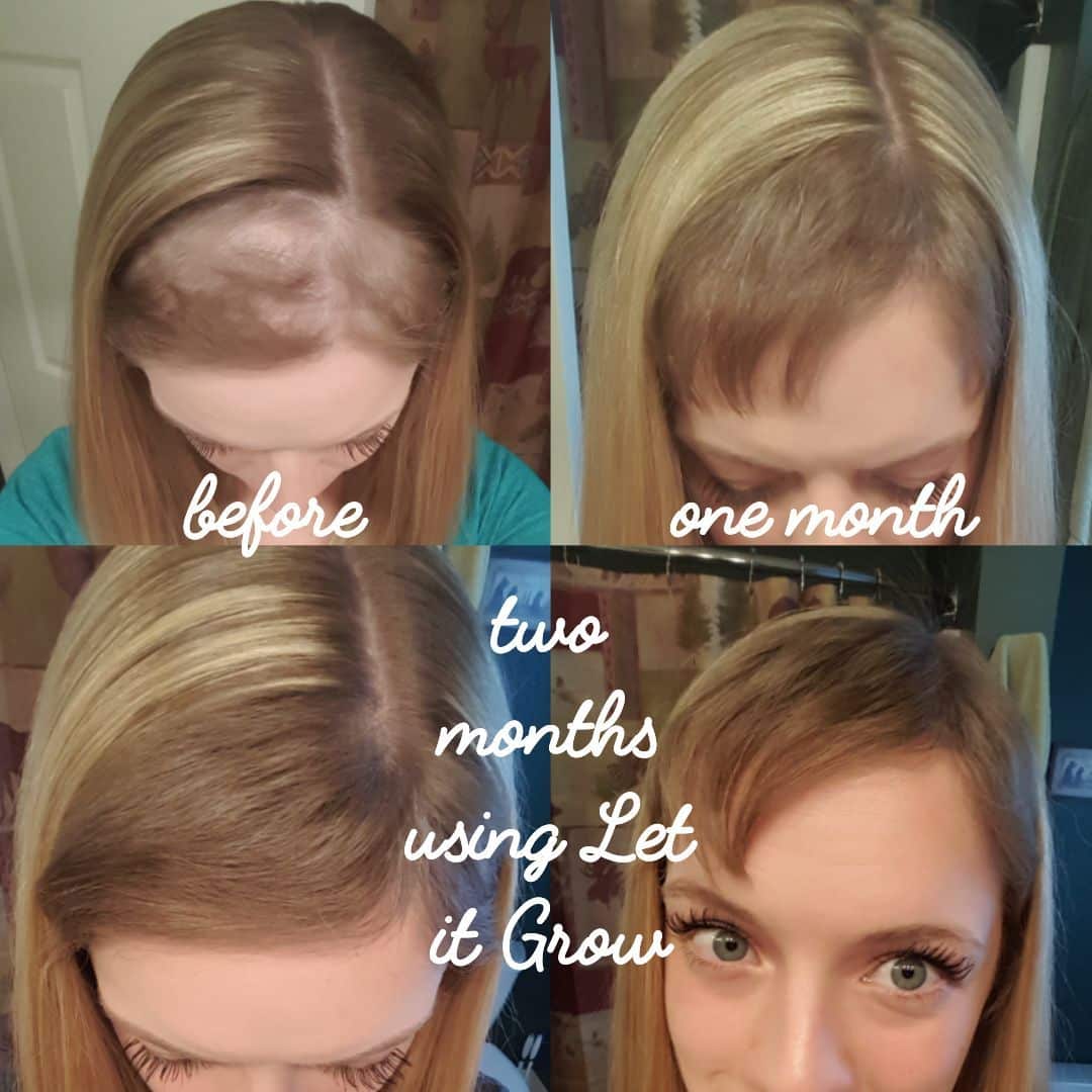 How Long Can Postpartum Hair Loss Last - HairLossProTalk.com