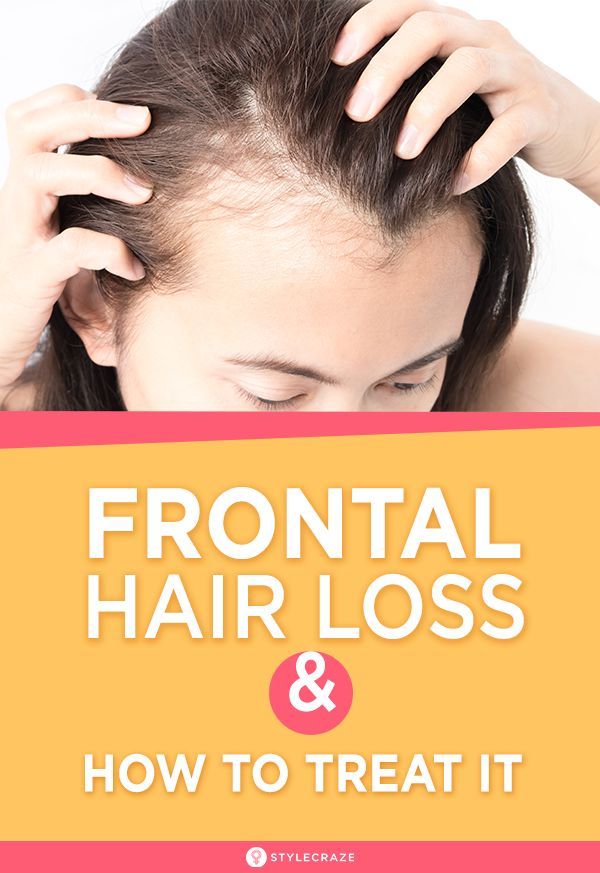 What Is Frontal Hair Loss And How To Treat It?